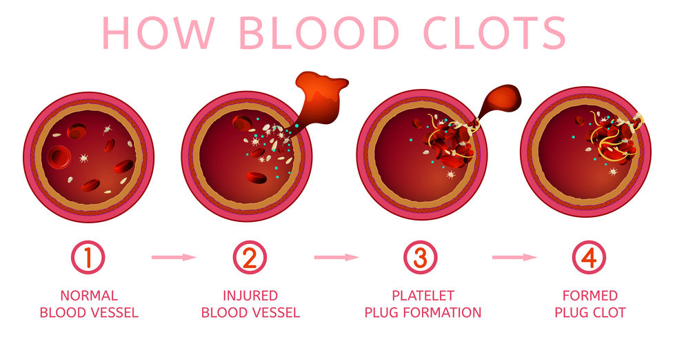 Top 25 what does it mean when platelets are low